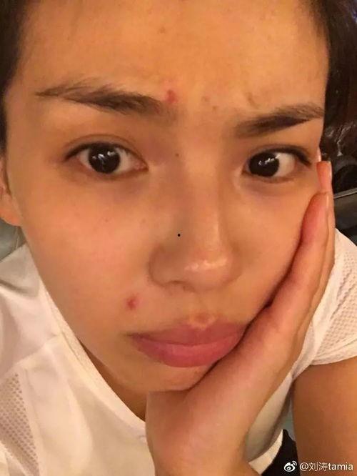 女明星 痘痘,揭秘明星护肤秘籍与痘痘对抗之道