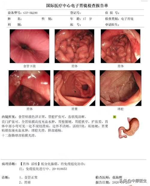 32岁网红胃癌晚期,年轻生命警示录